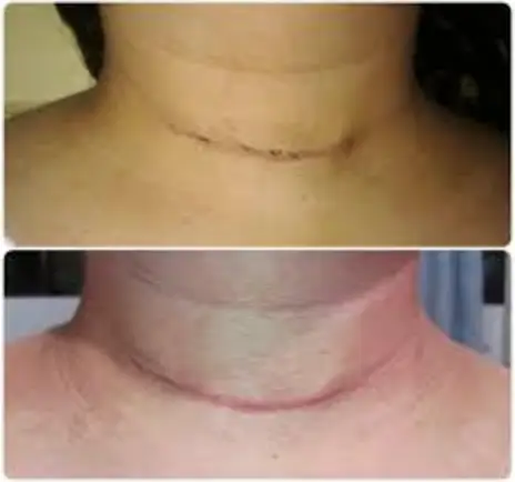 Cicatriz de cirurgia de tireoide